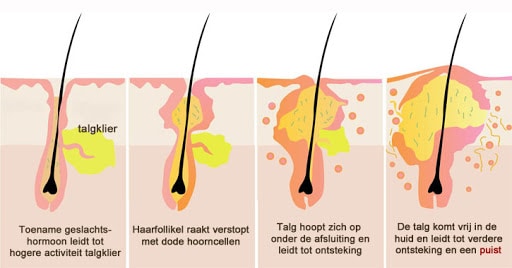 acne ontstaan