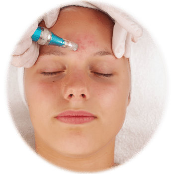 Microneedling